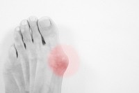 Different Reasons a Bunion May Develop