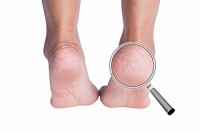 Reasons Cracked Heels Can Develop