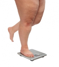 Foot Conditions Caused by Obesity