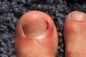 Try this life-changing product for thick toenails: Central Massachusetts  Podiatry: Podiatrists